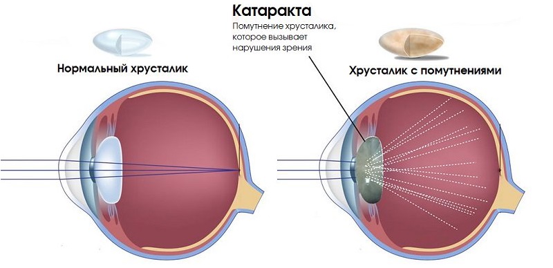что такое катаракта