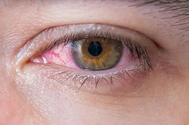 симптомы сухого глаза
