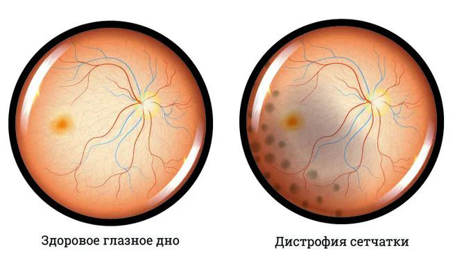 патология глазного дна, дистрофия сетчатки