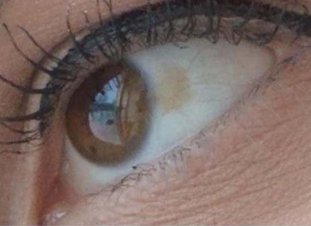 пленка в глазах и ухудшение зрения